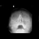 Chronic sinusitis, foreign body: X-ray - Plain radiograph